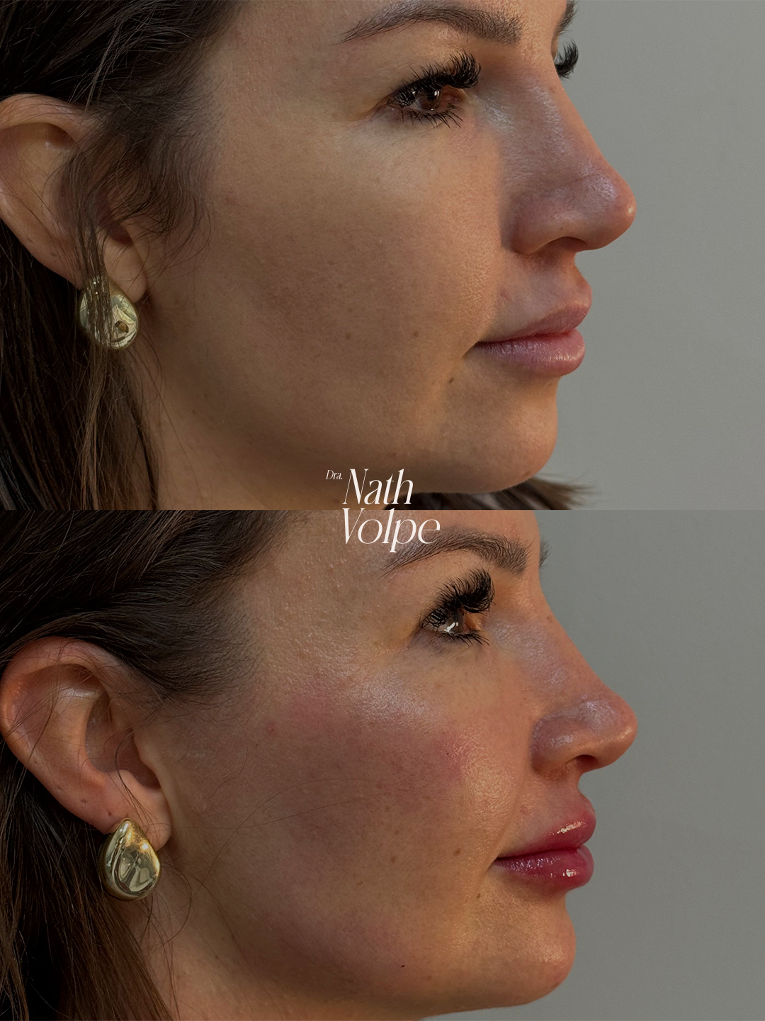 Resultado de antes e depois em tratamento estético - caso 2