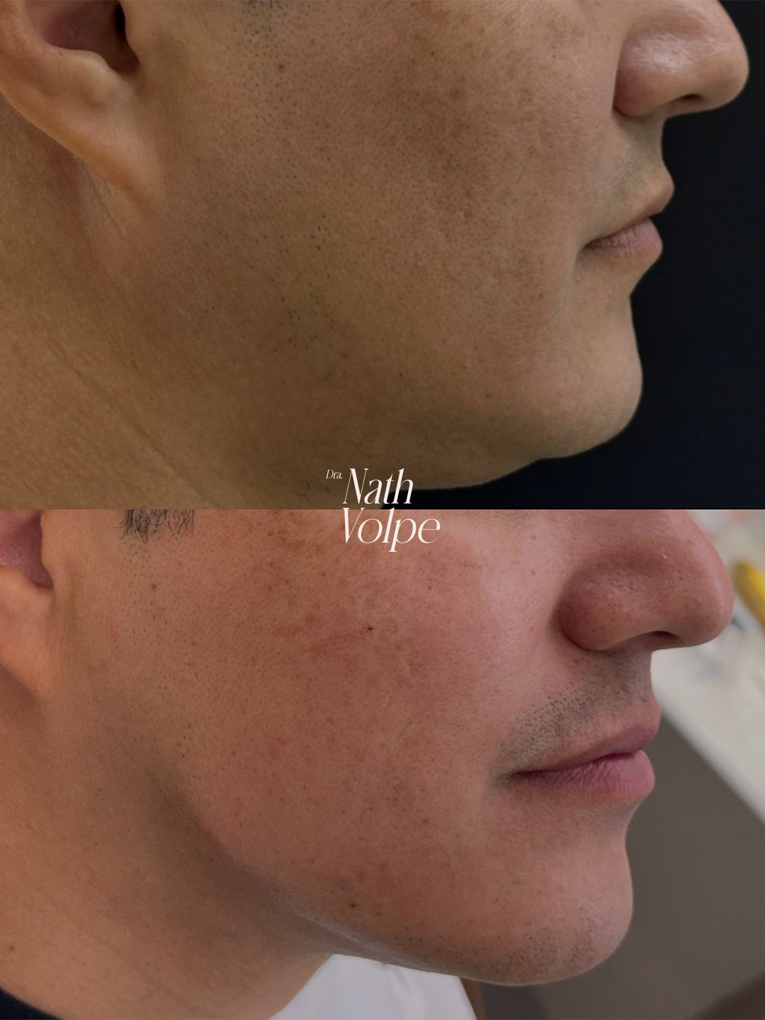 Resultado de antes e depois em tratamento estético - caso 3